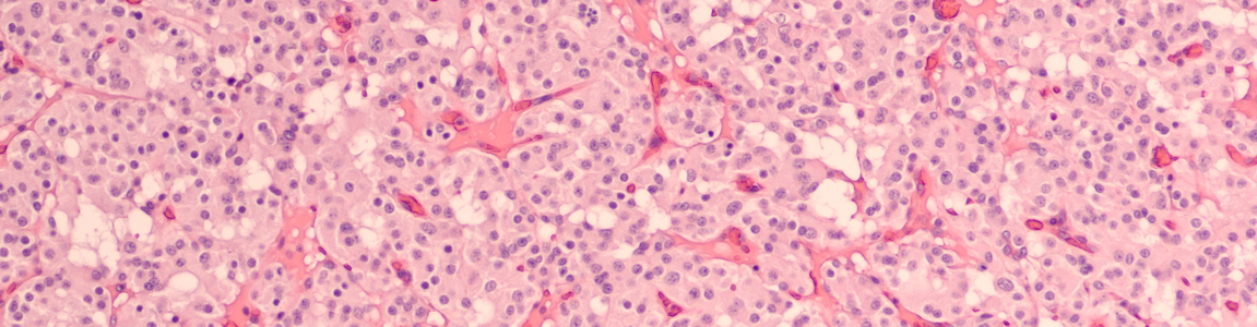 Tumore pancreas