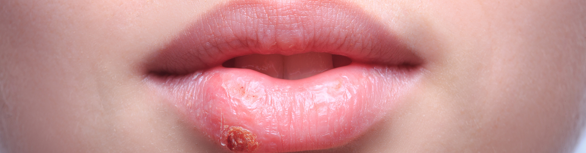 herpes herpes