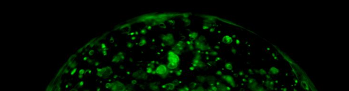 Campione tridimensionale di tumore al pancreas illuminato tramite luce laser verde