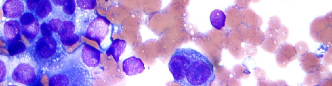 melanoma melanoma