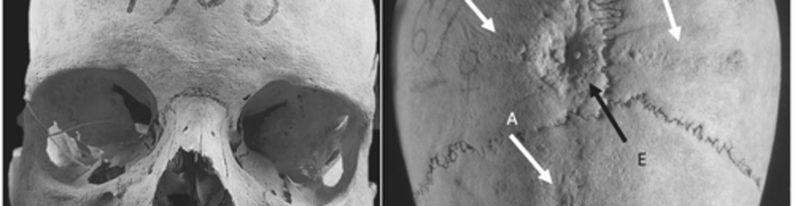 incisione cruciforme 