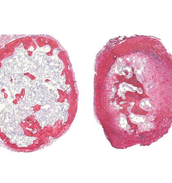 Creato un organoide di osso per studiare le malattie genetiche rare