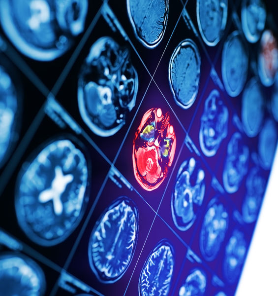 The study of neuroimaging further boosts the collaboration between Sapienza University of Rome and Fondazione Santa Lucia IRCCS 