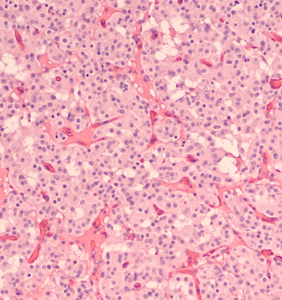 Una corona proteica per la diagnosi precoce del tumore del pancreas