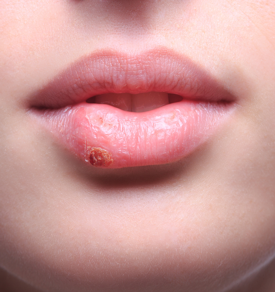 A Potential Risk Factor for Alzheimer’s Identified in the Herpes Simplex Virus