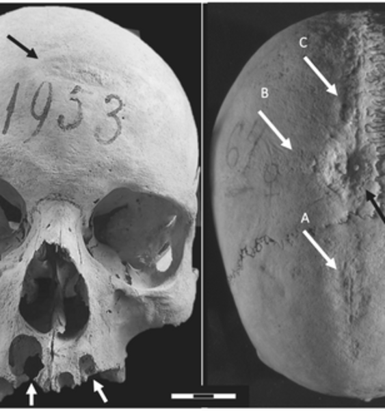Middle Ages and medicine: an unprecedented case of cranial surgery using a cruciform incision in Longobard Italy