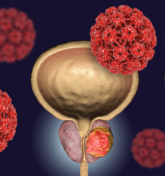 New Prostate Cancer Test Promises High Accuracy 