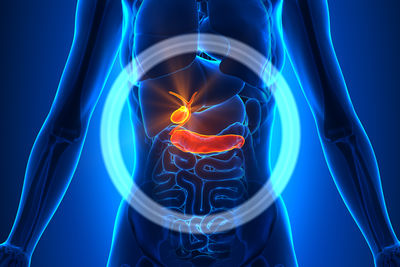 Tumore pancreas 